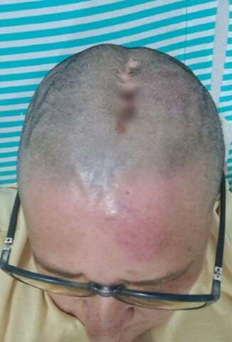 H&aacute; 3 anos com cr&acirc;nio exposto, vigilante acusa neglig&ecirc;ncia de hospital