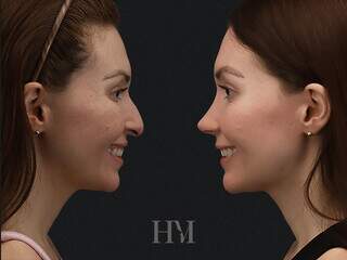 Rinoplastia híbrida une tecnologia e precisão para resultados mais harmônicos Rinoplastia híbrida une tecnologia e precisão para resultados mais harmônicos