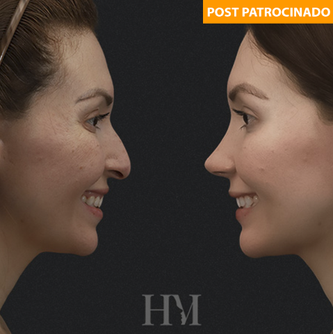 Rinoplastia híbrida une tecnologia e precisão para resultados mais harmônicos