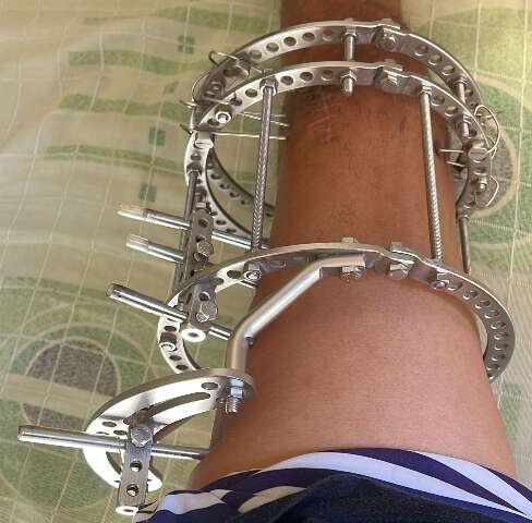 Atendente espera h&aacute; cinco meses para retirar &quot;gaiola&quot; da perna na Santa Casa
