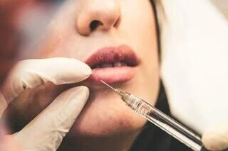 Apesar das críticas, Vigilância Sanitária mantém uso de preenchedor definitivo Apesar das críticas, Vigilância Sanitária mantém uso de preenchedor definitivo