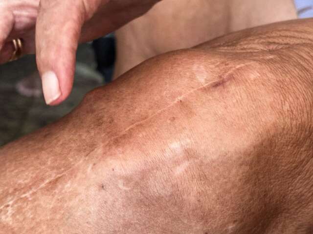 Falhas na ortopedia obrigam MS &agrave; despesa milion&aacute;ria com cirurgias particulares