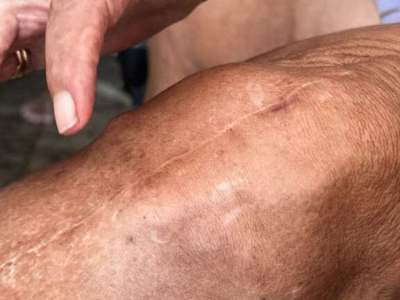 Falhas na ortopedia obrigam MS à despesa milionária com cirurgias particulares