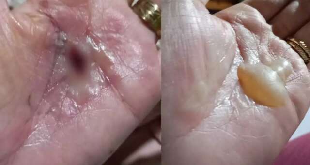 Mulheres denunciam pai de santo ap&oacute;s terem m&atilde;os queimadas com p&oacute;lvora