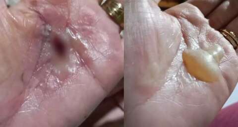 Mulheres denunciam pai de santo ap&oacute;s terem m&atilde;os queimadas com p&oacute;lvora