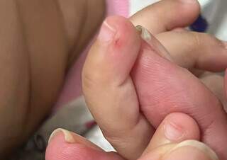 Beb&ecirc; de 1 ano &eacute; mordida por morcego, mas precisa de desespero?