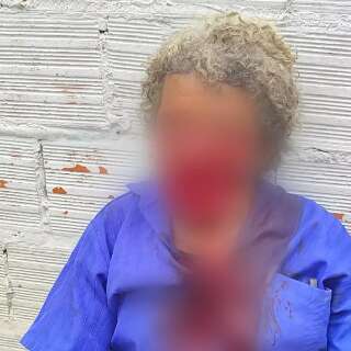 Ataque de pitbull deixa idoso em estado grav&iacute;ssimo e com rosto desfigurado