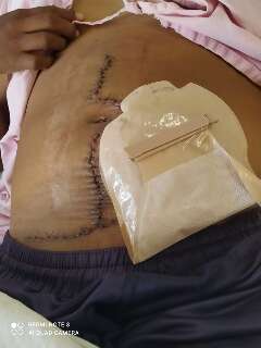 Mulher com gaze esquecida no corpo ap&oacute;s parto agora vive com colostomia