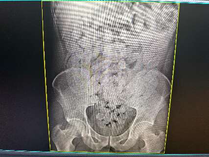 Oito bolivianos s&atilde;o flagrados com 645 c&aacute;psulas de coca&iacute;na no est&ocirc;mago