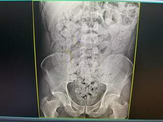 Oito bolivianos s&atilde;o flagrados com 645 c&aacute;psulas de coca&iacute;na no est&ocirc;mago