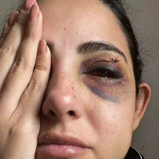 “Quis acabar comigo”: mulher denuncia ex por espancamento, estupro e cárcere “Quis acabar comigo”: mulher denuncia ex por espancamento, estupro e cárcere