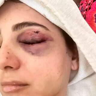 “Quis acabar comigo”: mulher denuncia ex por espancamento, estupro e cárcere “Quis acabar comigo”: mulher denuncia ex por espancamento, estupro e cárcere