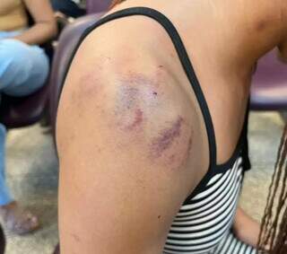 Por ci&uacute;mes, namorado tortura adolescente com marteladas na cabe&ccedil;a