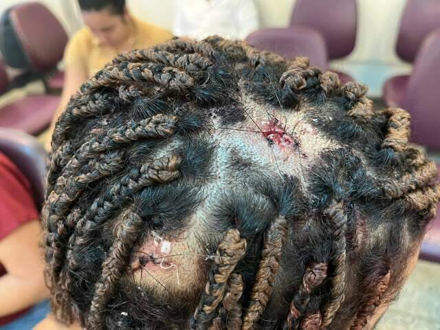 Por ci&uacute;mes, namorado tortura adolescente com marteladas na cabe&ccedil;a