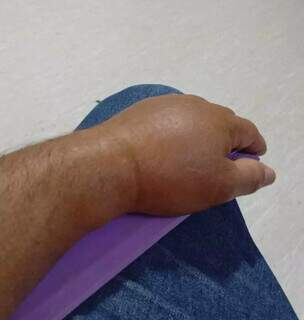 Moto entregador aguarda há uma semana por cirurgia no punho Moto entregador aguarda há uma semana por cirurgia no punho