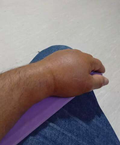 Moto entregador aguarda h&aacute; uma semana por cirurgia no punho 