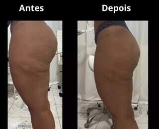 Na Cl&iacute;nica Corpo &amp; Pele, tirzepatida garante perda de peso saud&aacute;vel