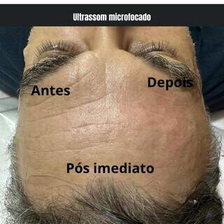 Na Cl&iacute;nica Corpo &amp; Pele, tirzepatida garante perda de peso saud&aacute;vel