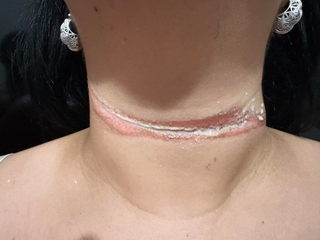 Professora é quase enforcada em 3º caso de fios soltos no mês Professora é quase enforcada em 3º caso de fios soltos no mês