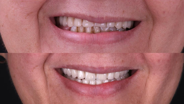 Est&eacute;tica conservadora: como melhorar o sorriso sem desgastar os dentes