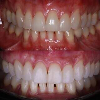 Est&eacute;tica conservadora: como melhorar o sorriso sem desgastar os dentes