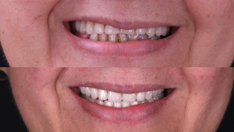 Estética conservadora: como melhorar o sorriso sem desgastar os dentes