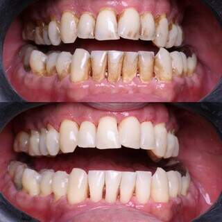 Est&eacute;tica conservadora: como melhorar o sorriso sem desgastar os dentes