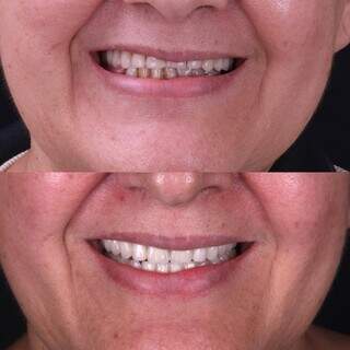 Est&eacute;tica conservadora: como melhorar o sorriso sem desgastar os dentes