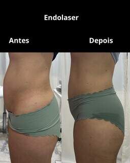 Na Cl&iacute;nica Corpo &amp; Pele, tirzepatida garante perda de peso saud&aacute;vel