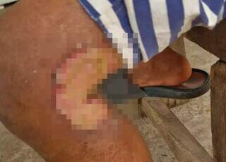 Criança é socorrida com queimaduras graves e polícia investiga maus-tratos Criança é socorrida com queimaduras graves e polícia investiga maus-tratos