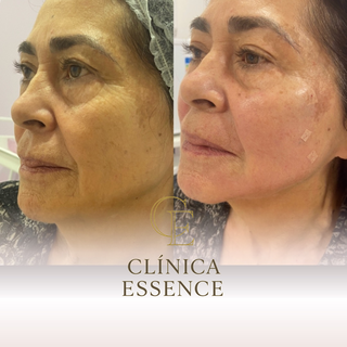 Procedimento est&eacute;tico promete rejuvenescimento facial e resultado imediato