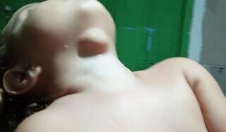 Ap&oacute;s anos de atraso, Campo Grande normaliza cirurgias para cisto no pesco&ccedil;o