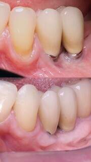 Dentes sensíveis e gengiva retraída: os sinais que não devem ser ignorados Dentes sensíveis e gengiva retraída: os sinais que não devem ser ignorados