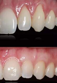 Dentes sensíveis e gengiva retraída: os sinais que não devem ser ignorados Dentes sensíveis e gengiva retraída: os sinais que não devem ser ignorados