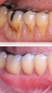 Dentes sensíveis e gengiva retraída: os sinais que não devem ser ignorados Dentes sensíveis e gengiva retraída: os sinais que não devem ser ignorados