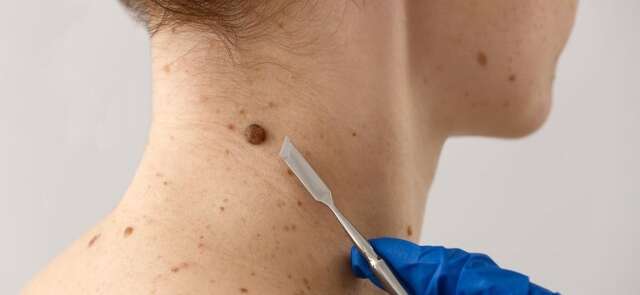 Mutir&atilde;o gratuito contra c&acirc;ncer de pele leva preven&ccedil;&atilde;o a Mato Grosso do Sul