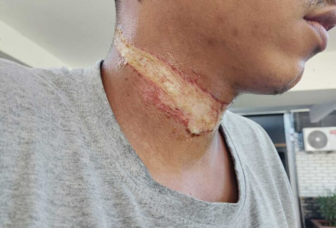 Corda atravessada em rua provoca acidente e quase degola motociclista