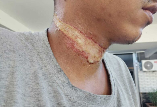 Corda atravessada em rua provoca acidente e quase degola motociclista