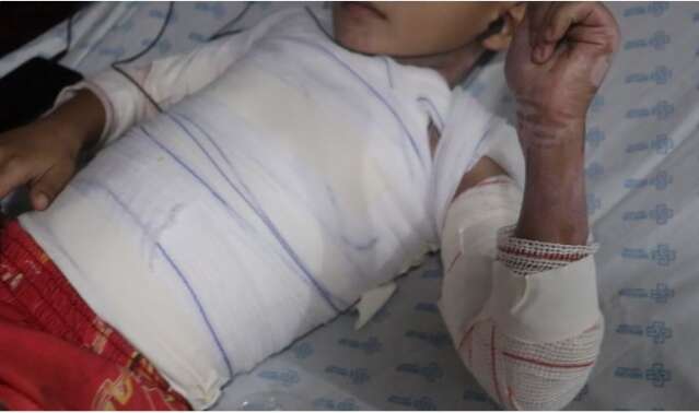 Queimaduras em crian&ccedil;as aumentam nas f&eacute;rias e maioria dos casos ocorre em casa