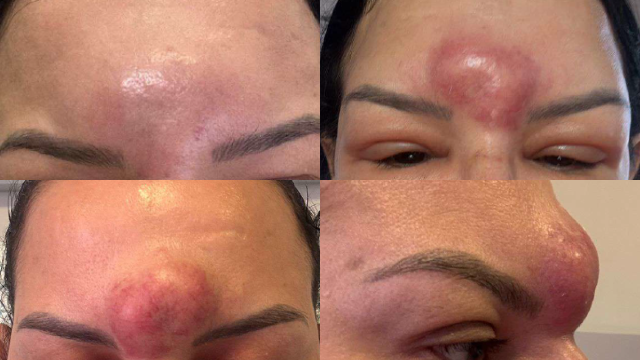 Cliente processa cl&iacute;nica ap&oacute;s contrair bact&eacute;ria em procedimento com &aacute;cido