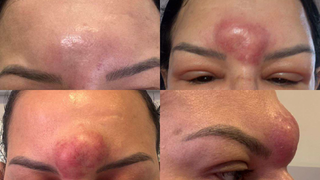 Cliente processa cl&iacute;nica de est&eacute;ticas ap&oacute;s uma bact&eacute;ria deformar o rosto 