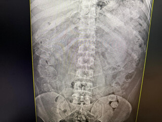 Bolivianos são presos após engolirem mais de 250 cápsulas de cocaína Bolivianos são presos após engolirem mais de 250 cápsulas de cocaína