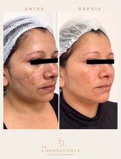 P&oacute;s-f&eacute;rias: tratar a pele agora pode evitar manchas mais dif&iacute;ceis no futuro