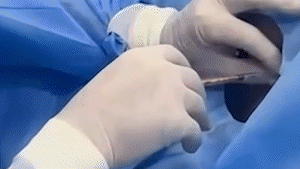 Por ordem judicial, MS faz 1&ordf; cirurgia com polilaminina em paciente tetrapl&eacute;gico