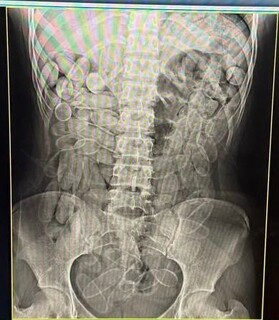 Jovens bolivianas s&atilde;o presas transportando 204 c&aacute;psulas de coca&iacute;na no est&ocirc;mago