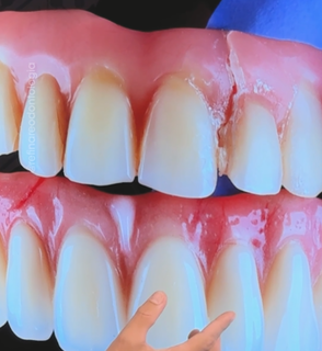 Pr&oacute;tese antiga pode comprometer a sa&uacute;de bucal e exigir substitui&ccedil;&atilde;o