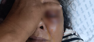 Florista &eacute; atingida por estilha&ccedil;os de bomba da PM e pode perder a vis&atilde;o