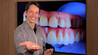 Pr&oacute;tese antiga pode comprometer a sa&uacute;de bucal e exigir substitui&ccedil;&atilde;o