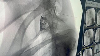 Ap&oacute;s cirurgia, esperan&ccedil;a &eacute; militar tetrapl&eacute;gico recuperar movimentos aos poucos