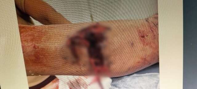 Pitbull ataca e dilacera perna de idoso de 73 anos em rancho 